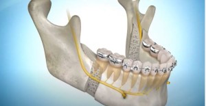 Chirurgie orthognatique ostéotomie mandibulaire
